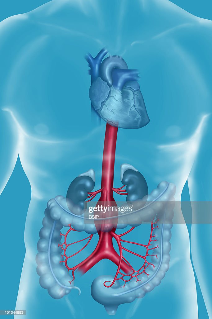 Subrenal Aneurysm Of The Abdominal Aorta. An Aneurysm Is A Localized ...