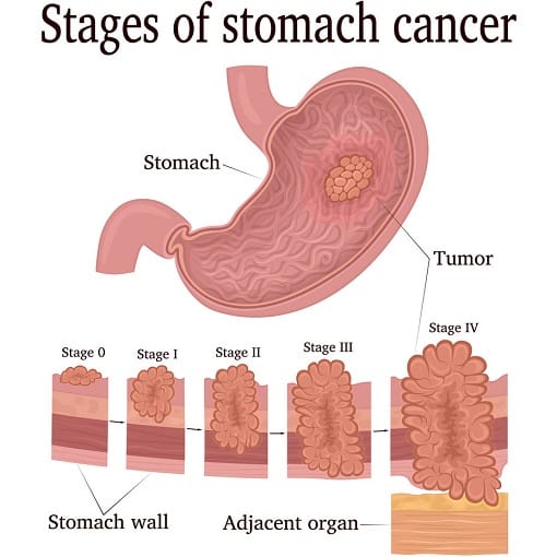 What is stomach cancer? Causes, symptoms, treatment of stomach cancer ...