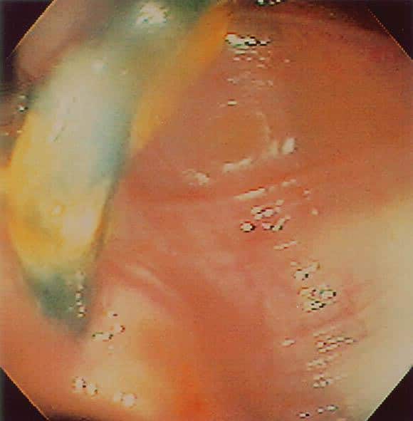 Abdominal pain and rectal bleeding as a complication of biliary stent ...
