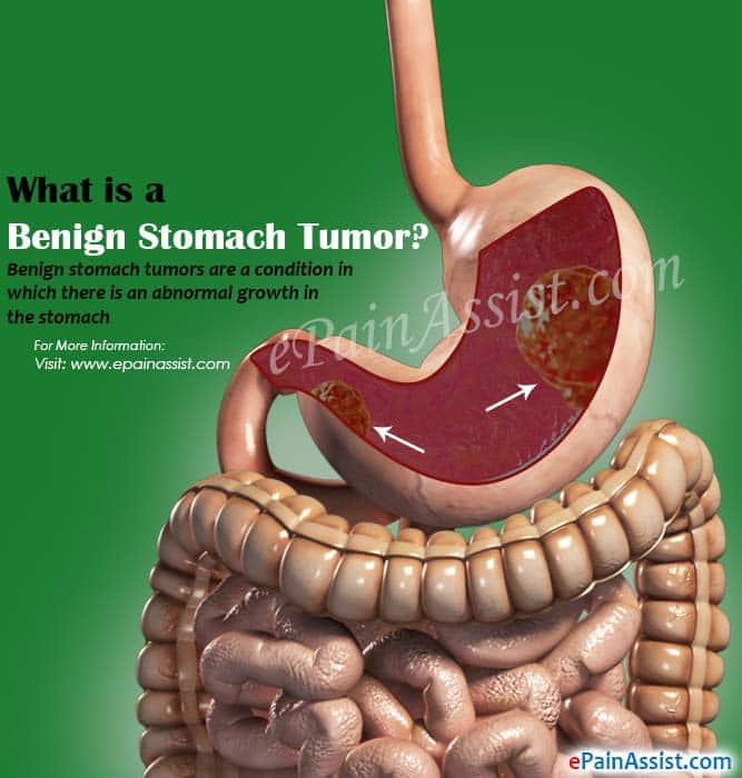 Causes of Benign Stomach Tumors: Its Symptoms and Treatment