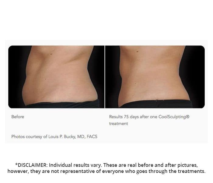 Coolsculpting Prices in Canada