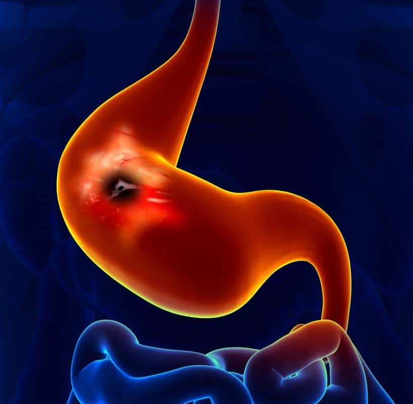 What is Gastritis? (with pictures)