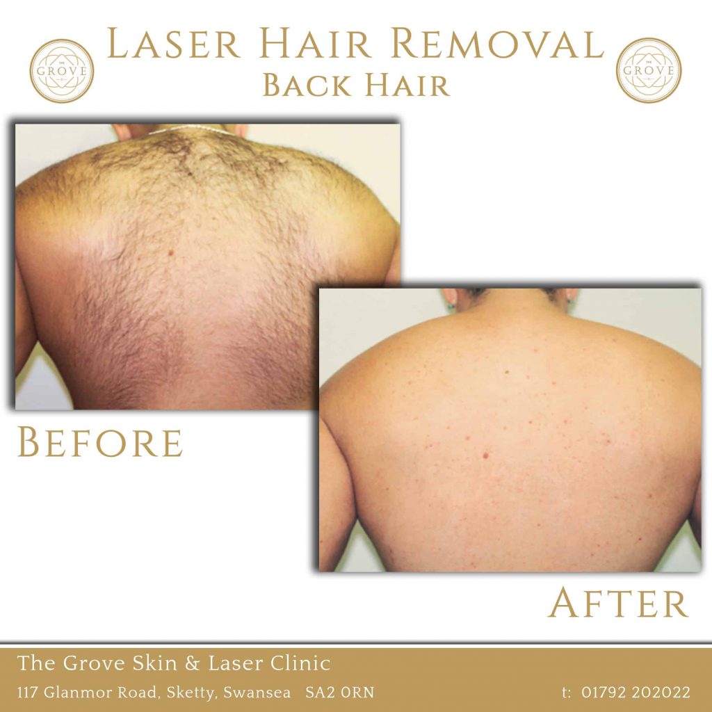 how-much-does-laser-hair-removal-cost-for-stomach-stomachguide