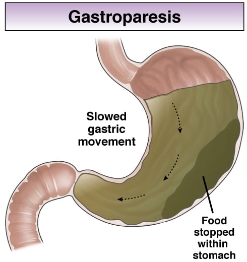 Гастропарез желудка. Диабетический гастропарез.